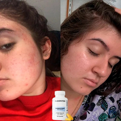 Años de acné hormonal, por fin solución